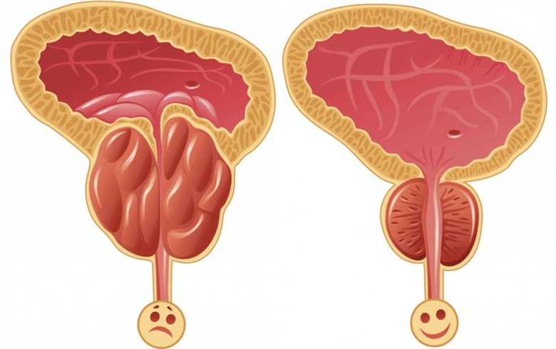 მამაკაცებში პოტენციის პრობლემების მიზეზები